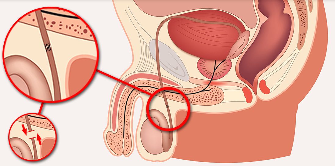 Reverso de Vasectomia - UROPROCT